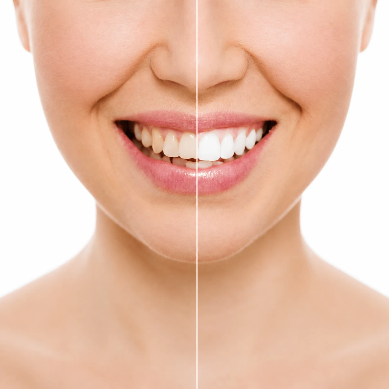 Teeth Whitening